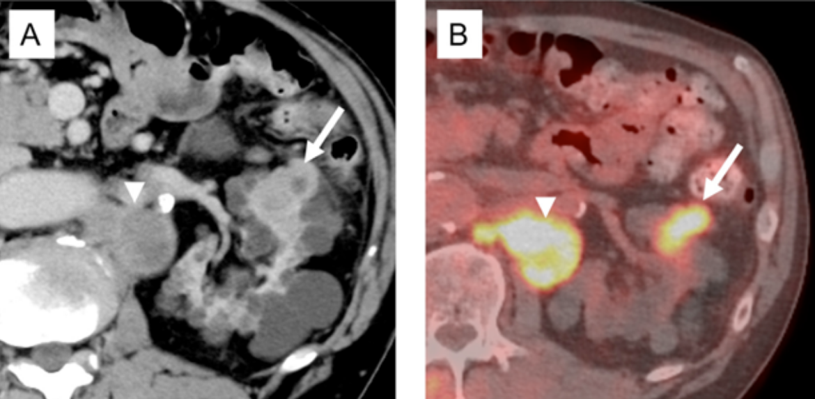 Fumarat hidrataz eksikliği tip renal hücreli karsinom tanılı 64 yaşında erkek hasta.