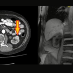 Böbrek Kanserinde FDG PET BT Gerçekten Yetersiz mi
