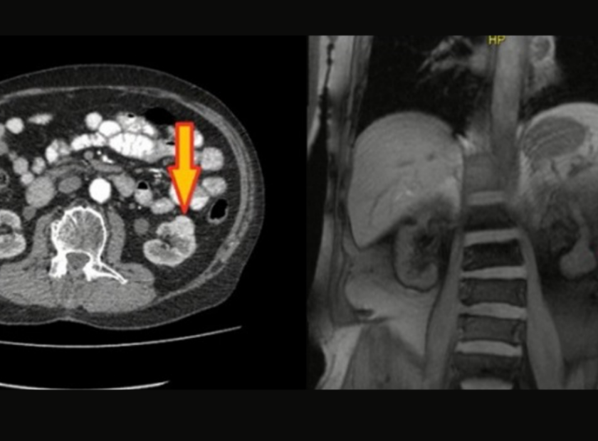 bobrek kanseri FDG PET BT 840x620
